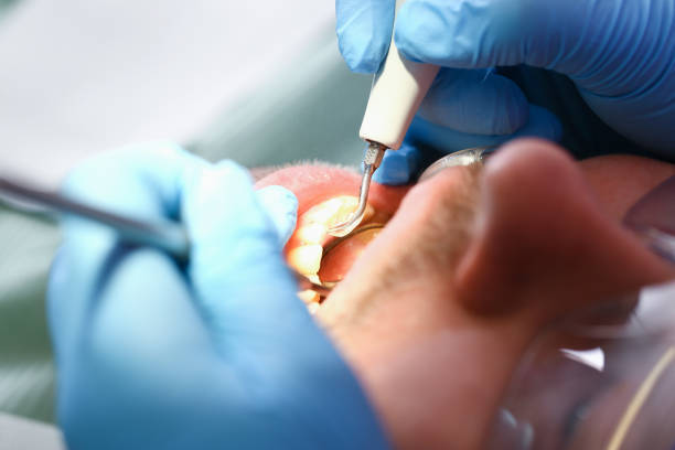 Best Emergency Wisdom Teeth Removal in Harvey, LA
