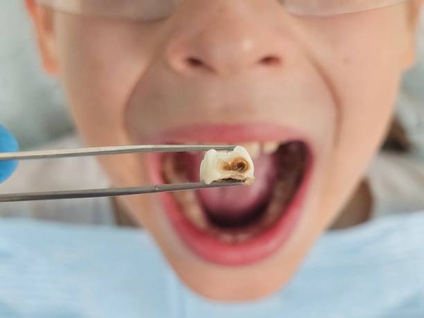 Best Emergency Wisdom Teeth Removal in Harvey, LA